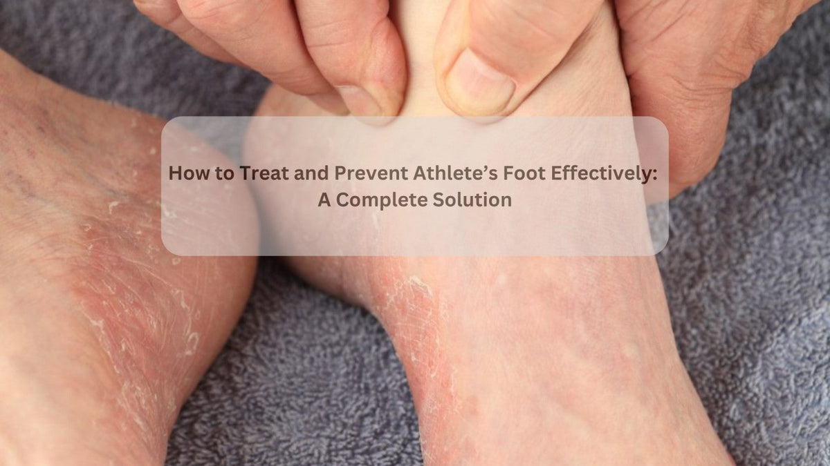 How to Treat and Prevent Athlete’s Foot Effectively: A Complete Solution